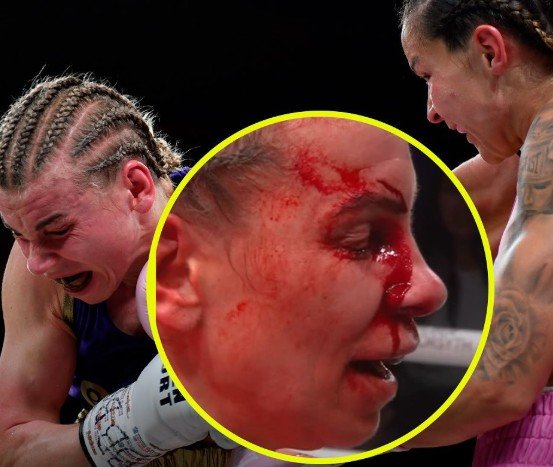 Close Up Photo Reveals Brutal Cut Injury Womens Boxer Suffered