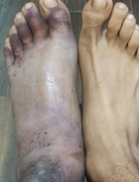 Boxer Fights On With Horrific Broken Foot Injury