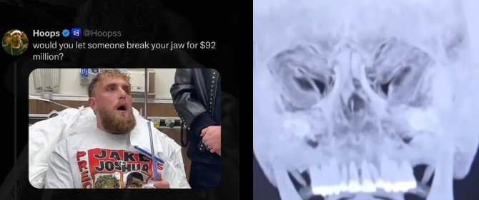 Jake Paul Hospital Scan After Joshua